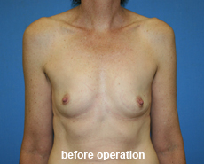 plastic-surgery-breast-augmentation